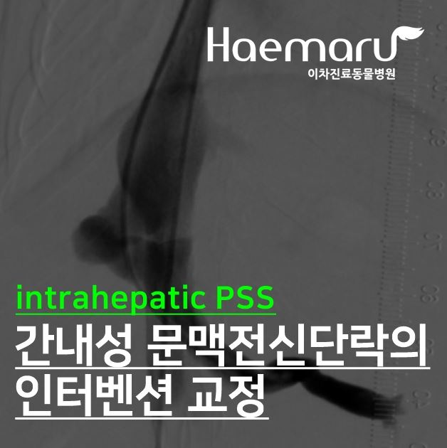 PSS 코일 색전술 케이스 - 간내성 문맥 전신 단락(IHPSS)의 인터벤션 교정 썸네일