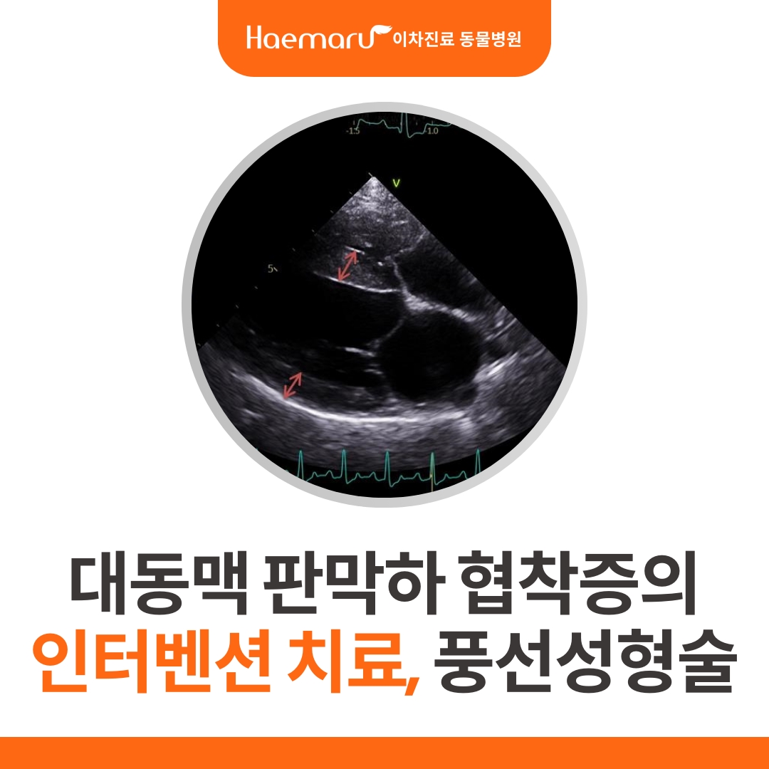 대동맥 판막하 협착증(SAS) 환자의 인터벤션 치료, 풍선 성형술 썸네일