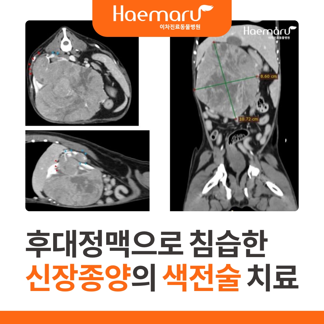 신장 종양의 인터벤션 치료 - 색전술을 통한 종양 크기 감소 썸네일