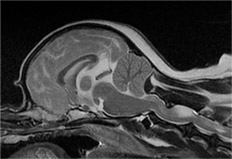 후두골 이형성 증후군 MRI