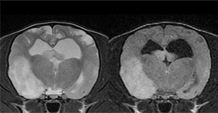 뇌수막염 MRI