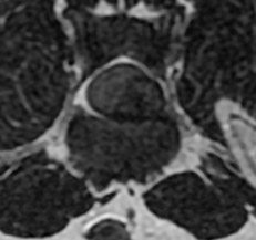 추간판 질환 MRI