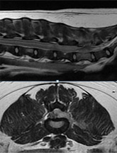 척수 종양 MRI